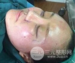 自體脂肪面部填充價位和案例