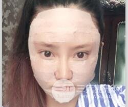 自體脂肪面部填充價位和案例