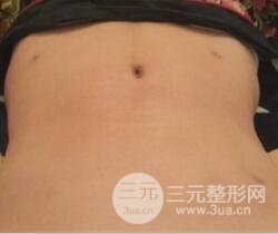 腹部抽脂價格和恢復案例