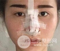 鼻子整形恢復(fù)過(guò)程真人案例
