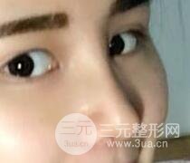 鼻子整形恢復(fù)過(guò)程真人案例