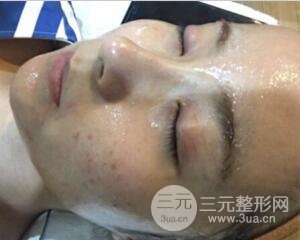 注射水光補水價格和案例圖片