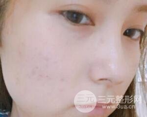 注射水光補水價格和案例圖片
