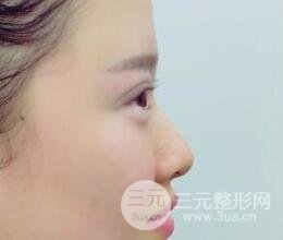 三點(diǎn)定位雙眼皮整形恢復(fù)圖案例