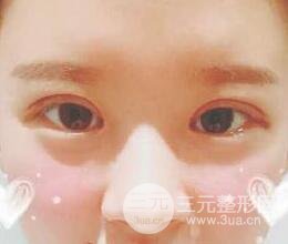 三點(diǎn)定位雙眼皮整形恢復(fù)圖案例