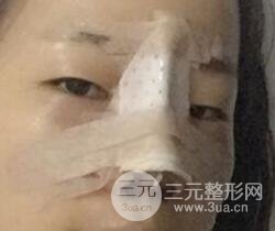 硅膠隆鼻+耳軟骨墊鼻尖+鼻小柱延長(zhǎng)案例