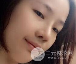 硅膠隆鼻+耳軟骨墊鼻尖+鼻小柱延長(zhǎng)案例