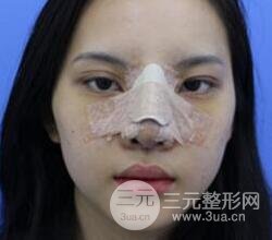 上海鼻子整形專家、價(jià)格和案例