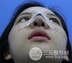 上海鼻子整形專家、價(jià)格和案例