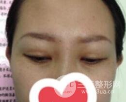 雙眼皮修復(fù)術(shù)價(jià)錢和案例圖
