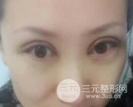 雙眼皮修復(fù)術(shù)價(jià)錢和案例圖