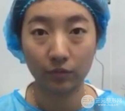 微創(chuàng)內(nèi)切去眼袋手術(shù)價格和恢復(fù)過程圖案例