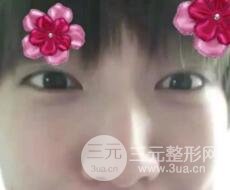 微創(chuàng)內(nèi)切去眼袋手術(shù)價(jià)格和恢復(fù)過程圖案例
