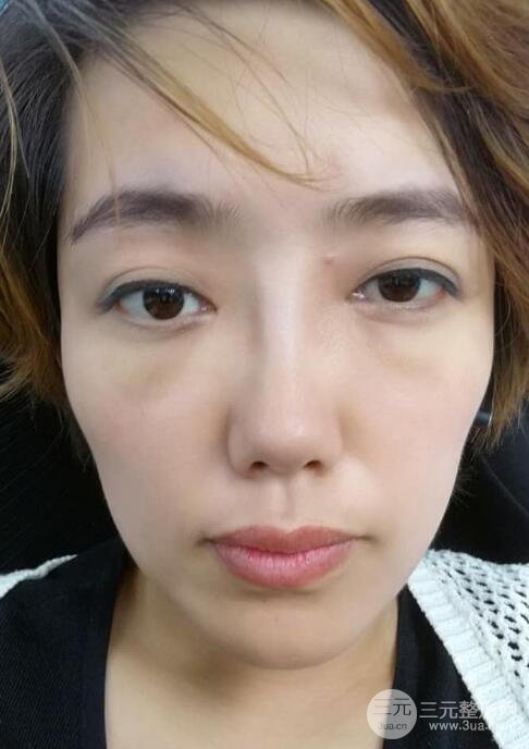 超聲法去眼袋價格和前后圖片案例