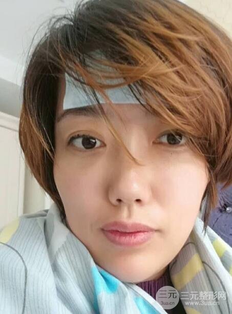 超聲法去眼袋價格和前后圖片案例