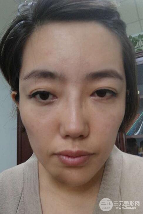 超聲法去眼袋價格和前后圖片案例