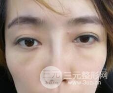 超聲法去眼袋價(jià)格和前后圖片案例