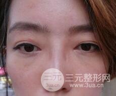 超聲法去眼袋價(jià)格和前后圖片案例