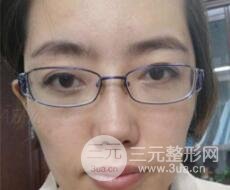 超聲法去眼袋價(jià)格和前后圖片案例