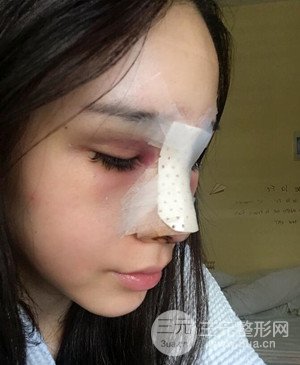 武漢美都張召醫(yī)生給我做的隆鼻整形手術(shù)，給大家分享一下前后照片