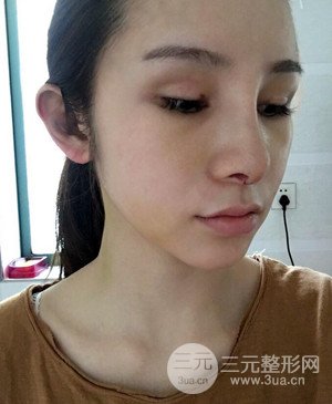 武漢美都張召醫(yī)生給我做的隆鼻整形手術(shù)，給大家分享一下前后照片