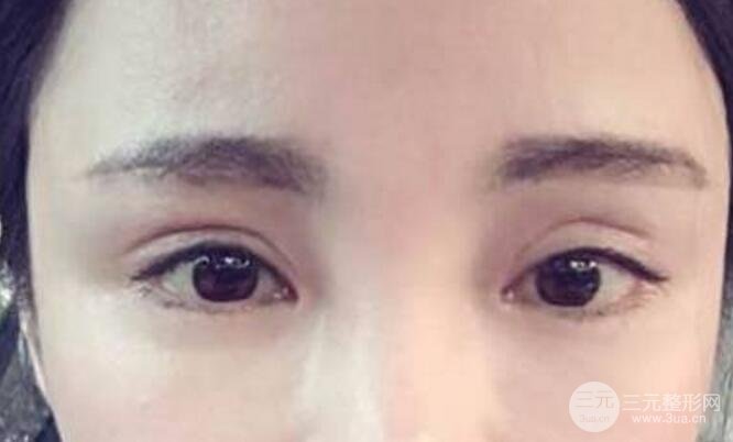 割雙眼皮失敗修復成功價格和案例圖片