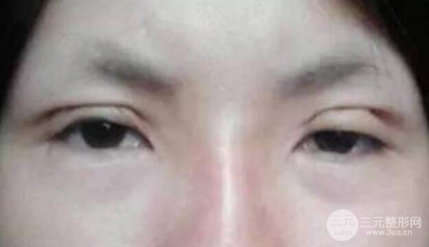 割雙眼皮失敗修復成功價格和案例圖片