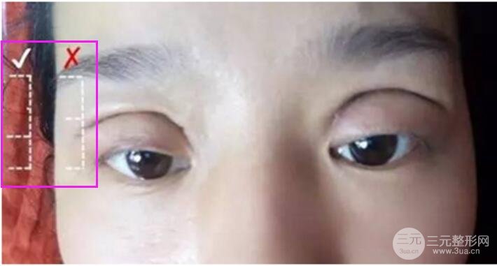 割雙眼皮失敗修復成功價格和案例圖片