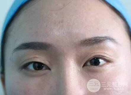 割雙眼皮失敗修復成功價格和案例圖片