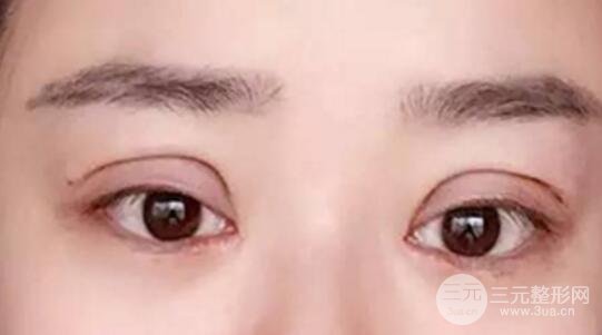 割雙眼皮失敗修復成功價格和案例圖片