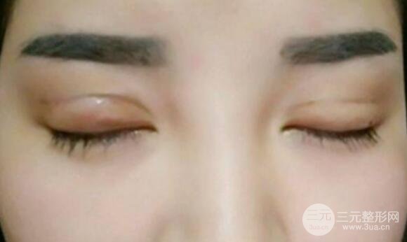 割雙眼皮失敗修復成功價格和案例圖片