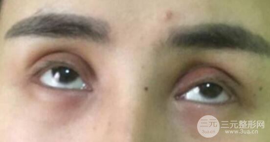 割雙眼皮失敗修復成功價格和案例圖片
