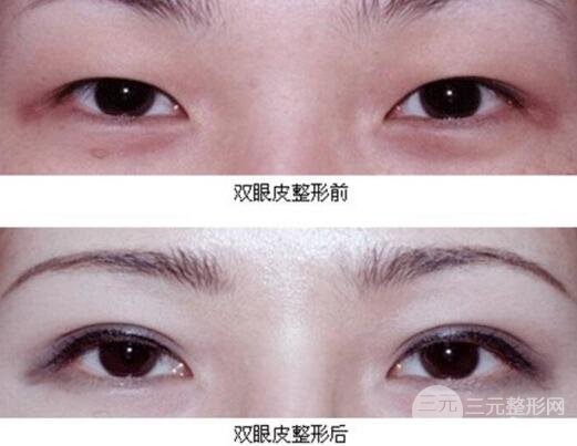 割雙眼皮失敗修復成功價格和案例圖片
