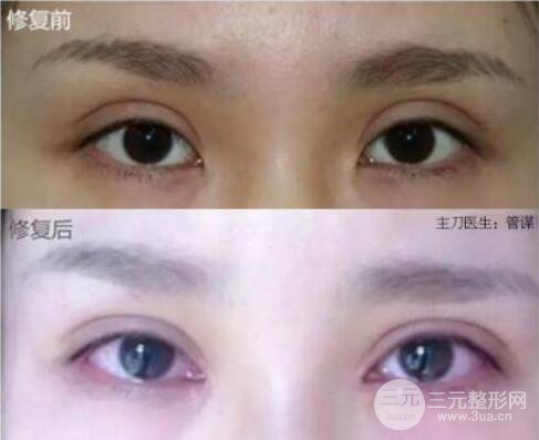 割雙眼皮失敗修復成功價格和案例圖片