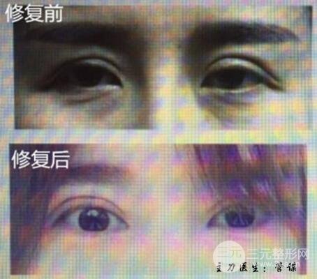 割雙眼皮失敗修復成功價格和案例圖片