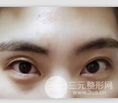 割雙眼皮失敗修復(fù)成功價(jià)格和案例圖片