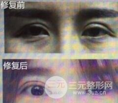 割雙眼皮失敗修復(fù)成功價(jià)格和案例圖片