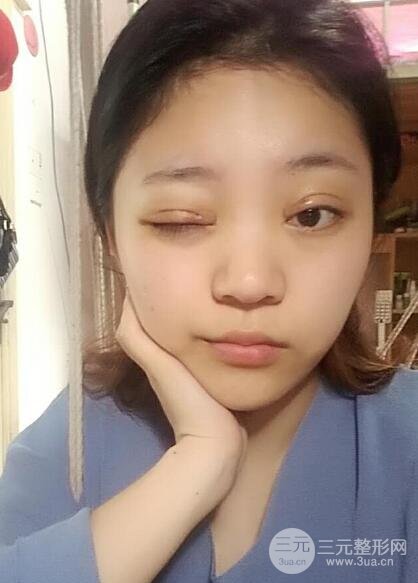 切開(kāi)雙眼皮手術(shù)恢復(fù)過(guò)程圖案例