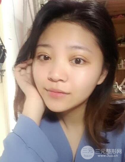 切開(kāi)雙眼皮手術(shù)恢復(fù)過(guò)程圖案例