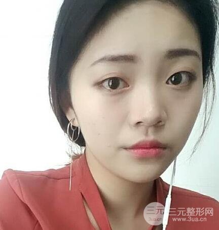 切開(kāi)雙眼皮手術(shù)恢復(fù)過(guò)程圖案例