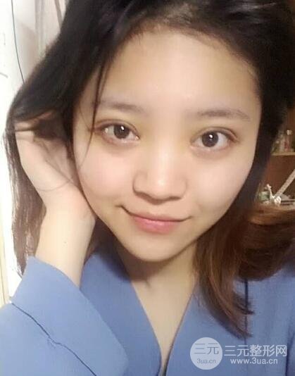 切開(kāi)雙眼皮手術(shù)恢復(fù)過(guò)程圖案例