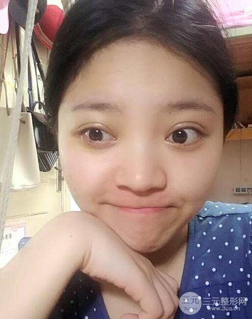 切開(kāi)雙眼皮手術(shù)恢復(fù)過(guò)程圖案例