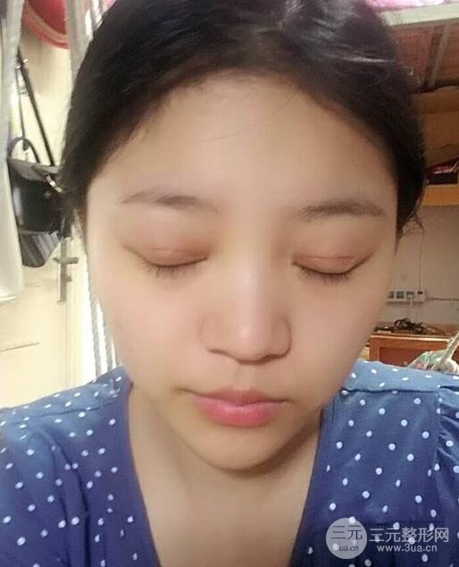 切開(kāi)雙眼皮手術(shù)恢復(fù)過(guò)程圖案例