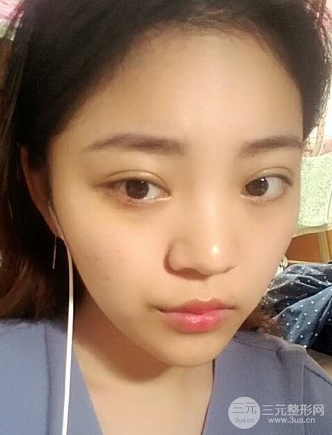 切開(kāi)雙眼皮手術(shù)恢復(fù)過(guò)程圖案例