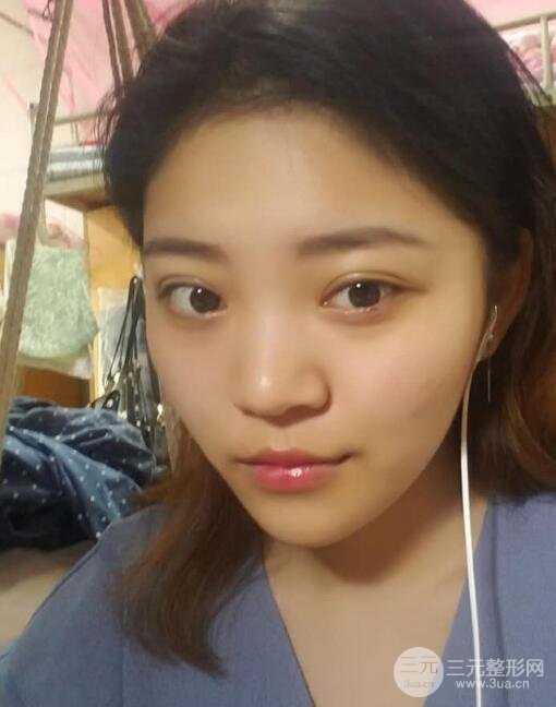 切開(kāi)雙眼皮手術(shù)恢復(fù)過(guò)程圖案例