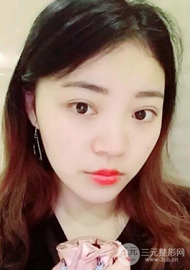 切開(kāi)雙眼皮手術(shù)恢復(fù)過(guò)程圖案例