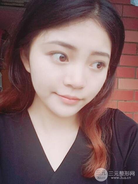 切開(kāi)雙眼皮手術(shù)恢復(fù)過(guò)程圖案例