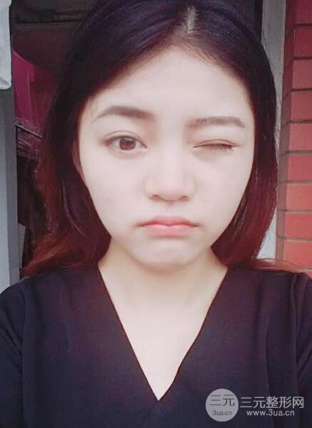 切開(kāi)雙眼皮手術(shù)恢復(fù)過(guò)程圖案例