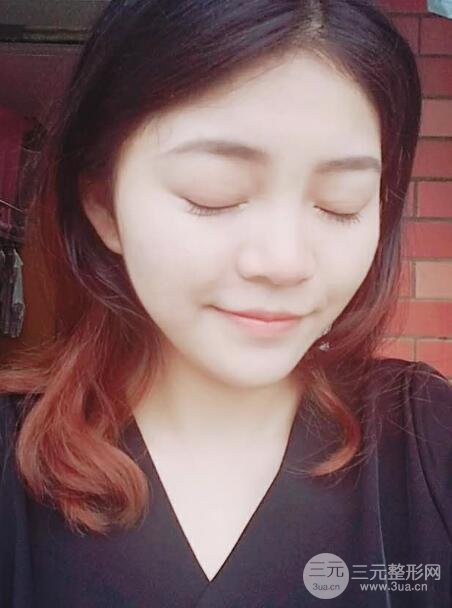 切開(kāi)雙眼皮手術(shù)恢復(fù)過(guò)程圖案例