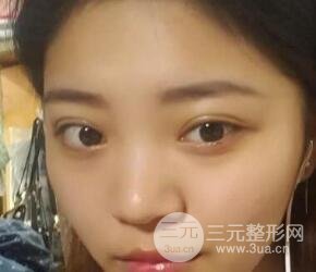 切開雙眼皮手術(shù)恢復(fù)過程圖案例